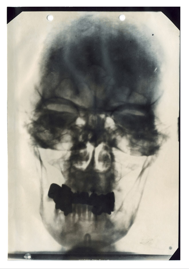 This is one of five known X-rays of Hitler’s head, part of his medical records compiled by American military intelligence after the German’s surrendered and declassified in 1958. The records also include doctor’s reports, diagrams of his teeth and nose and electrocardiograms. He had bad teeth, lots of fillings and crowns.