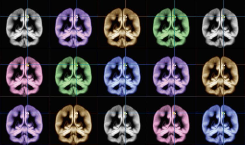 Scientists used MRI brain scans to identify happiness in a brain region known as the precuneus. (Photo: Kyoto University)